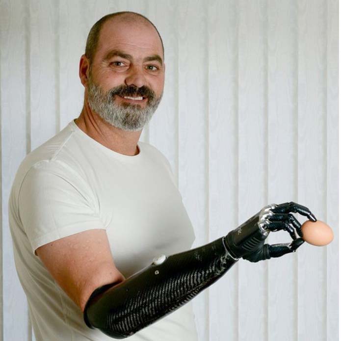 Be-Bionic Əl Protezi
